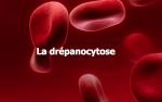 Santé : Ce qu'il faut savoir sur la drépanocytose